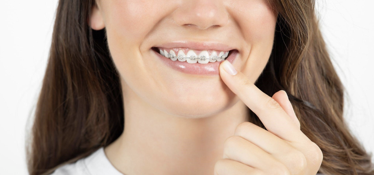 Can You Do Mewing with Braces, or Avoid It? Guide]